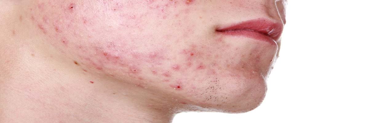 Lees meer over het artikel Veroorzaakt scheren jeugdpuistjes (acne)?