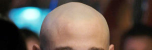 Lees meer over het artikel Glimmende hoofdhuid (kaal hoofd) voorkomen